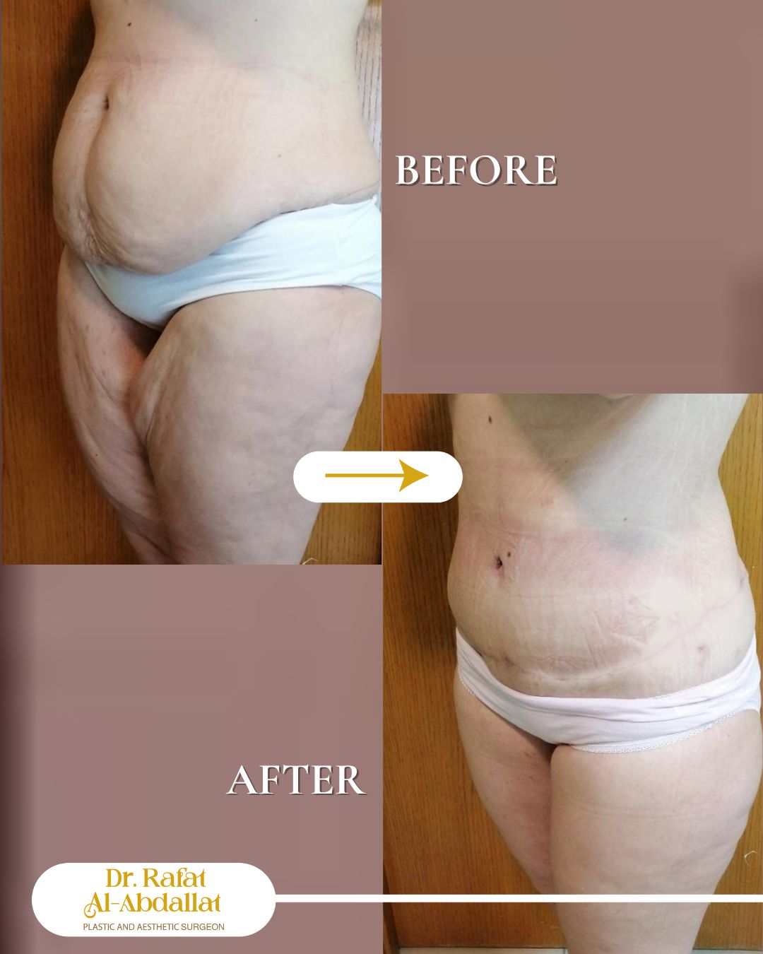 لما يرجع الجسم متوازن…
الثقة بترجع لحالها 🤍
نتائج عملية شد البطن والأفخاذ

📍الموقع: مجمع الزنبقة الطبي، شارع ابن خلدون (الخالدي)، ط5 - عمان
📞 للحجز والإستفسار: 0798672233