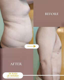 لما يختفي الشي اللي كان مزعجك،
راحتك بتصير واضحة بكل حركة.

📍الموقع: مجمع الزنبقة الطبي، شارع ابن خلدون (الخالدي)، ط5 - عمان
📞 للحجز والإستفسار: 0798672233
 #جراحة #عمليات_التثدي  #شفط_الدهون