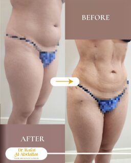 ✨ الفرق مش بس بالشكل… الفرق بالإحساس كمان

نحت الجسم رباعي الأبعاد بتقنية الفيزر مع د. رأفت العبداللات يعطيك تحديد دقيق، إبراز طبيعي للعضلات، ونتائج متناسقة تعكس جمال جسمك الحقيقي 💫

التحول واضح… والثقة أوضح 👌
هل أنت جاهزة تشوفِ أفضل نسخة من نفسك؟

📍الموقع: مجمع الزنبقة الطبي، شارع ابن خلدون (الخالدي)، ط5 - عمان
📞 للحجز والإستفسار: 0798672233

#نحت_الجسم #الفيزر #تجميل #شد_الجسم #AuraLux