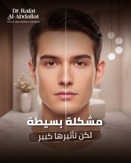 عملية تصحيح الأذن البارزة 
✔️ إجراء بسيط
✔️ نتائج دائمة
✔️ تغيير واضح في الثقة بالنفس
💬 أحيانًا تفصيلة صغيرة… تغيّر شعورك كله

📩 احجزي استشارتك الآن وابدئي رحلتك بثقة
📍الموقع: مجمع الزنبقة الطبي، شارع ابن خلدون (الخالدي)، ط5 - عمان
📞 للحجز والإستفسار: 0798672233

#دكتور_رأفت_العبداللات #AuraLuxClinics #DrRafatAlAbdallat #تجميل_الأذن #الأذن_البارزة #عملية_تجميل_الأذن #تجميل_الاذن #الاذن_البارزة #تجميل_الوجه #Otoplasty #EarSurgery #ProminentEars